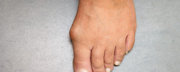 Hallux Valgus