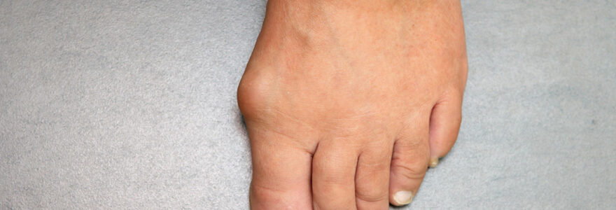 Hallux Valgus